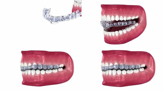 咬合夹板-咬合矫正。医学上精确的牙科3D插图