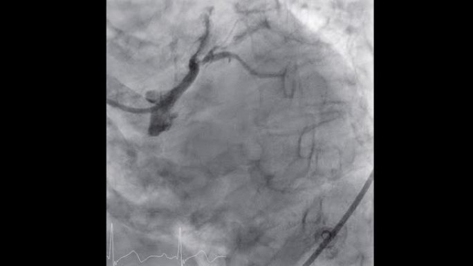 显示冠状动脉的心导管检查以诊断心脏骤停。