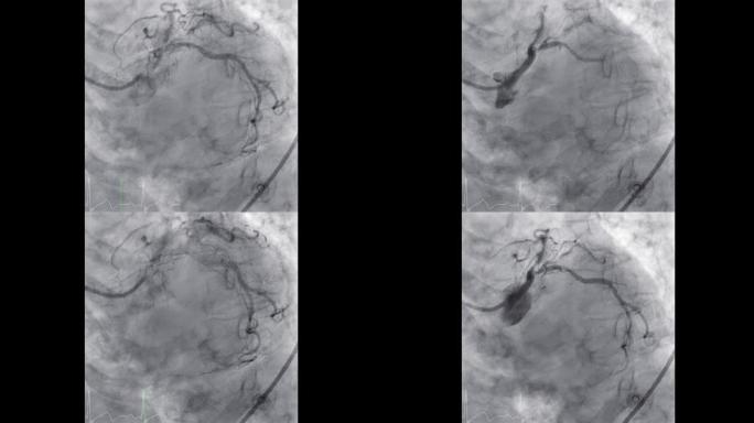 显示冠状动脉的心导管检查以诊断心脏骤停。