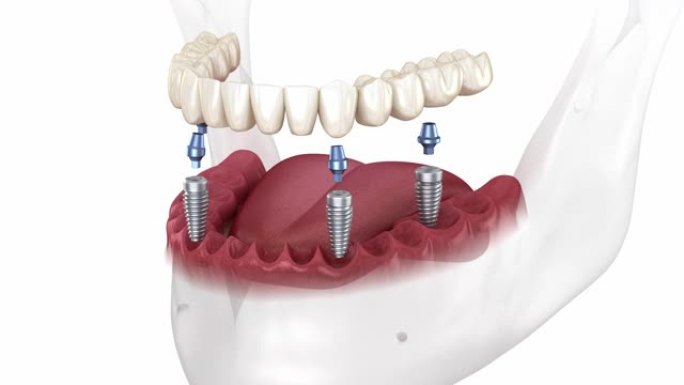 下颌假体全4系统由植入物支撑。医学上精确的3D动画