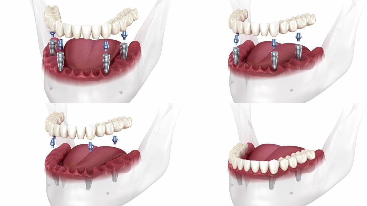 下颌假体全4系统由植入物支撑。医学上精确的3D动画