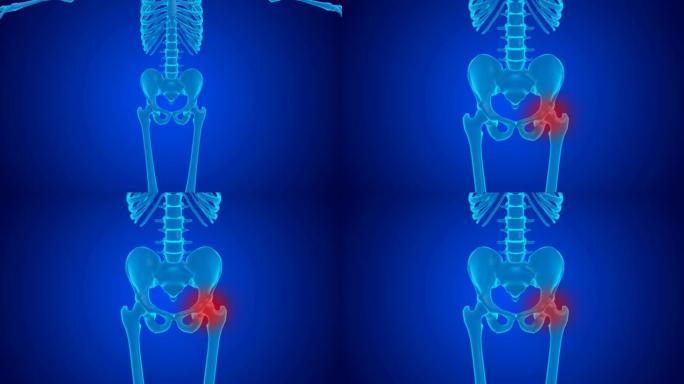 软骨磨损引起的股骨关节蓝色全息疼痛。