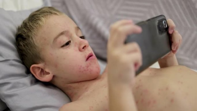 男孩，躺在床上，用手机玩电子游戏，而他的皮肤上长满了痘