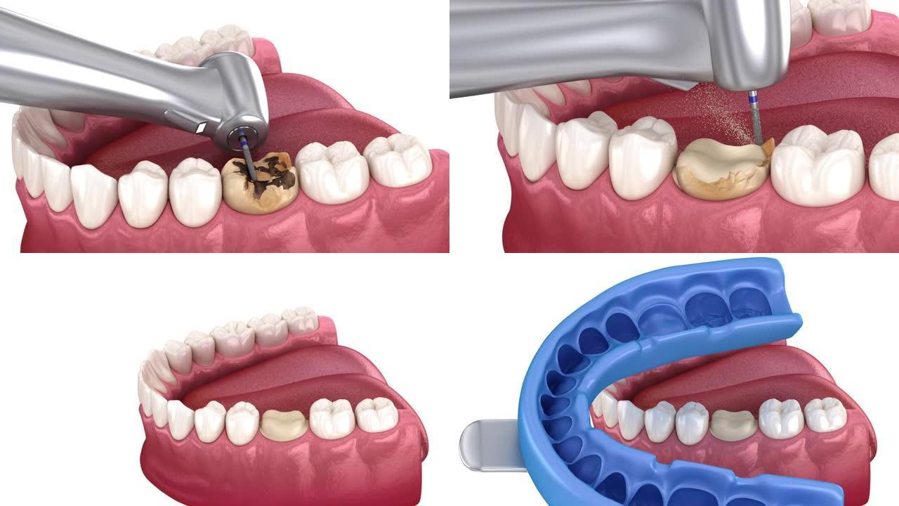 龋齿去除，准备，牙齿印模和牙冠放置。3D动画
