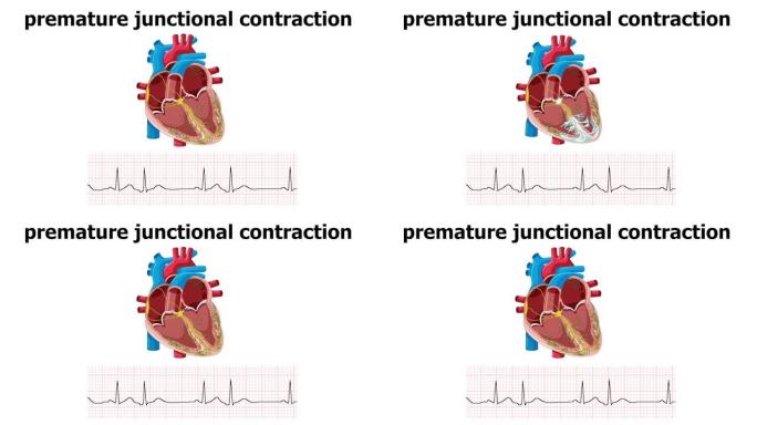 心脏动画与ecg过早的连接收缩