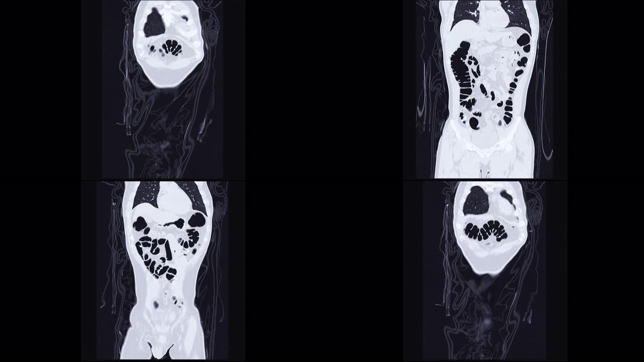 CT结肠造影冠状视图。