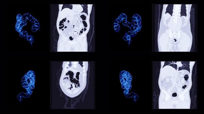 CT结肠造影三维渲染。