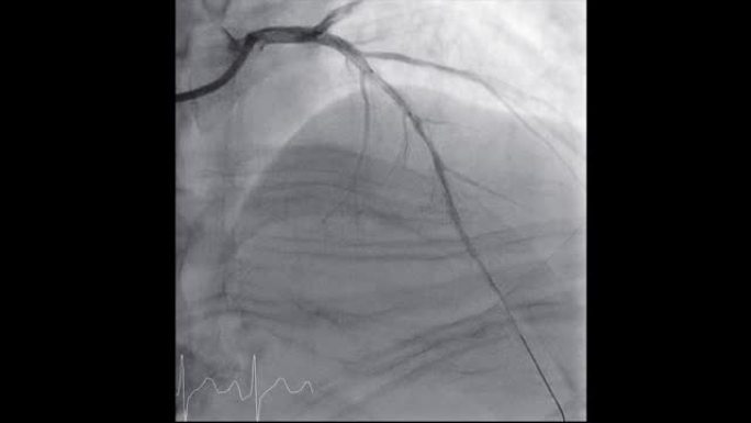 显示冠状动脉的心导管检查以诊断心脏骤停。