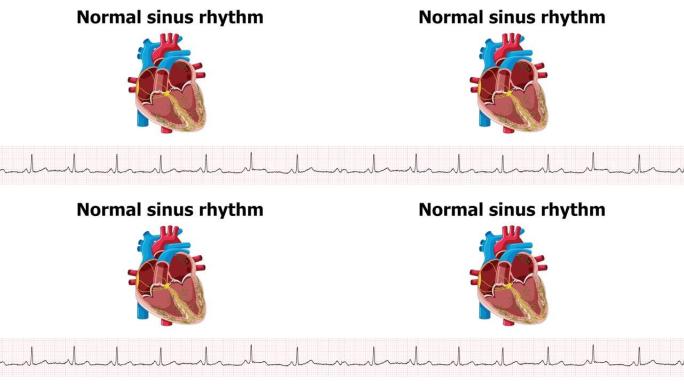 心电图正常窦性心律的心脏动画