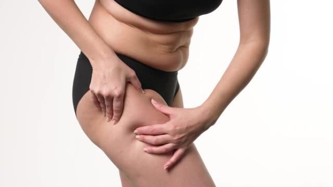 女人压迫腿部皮肤，检查脂肪团，妊娠纹。