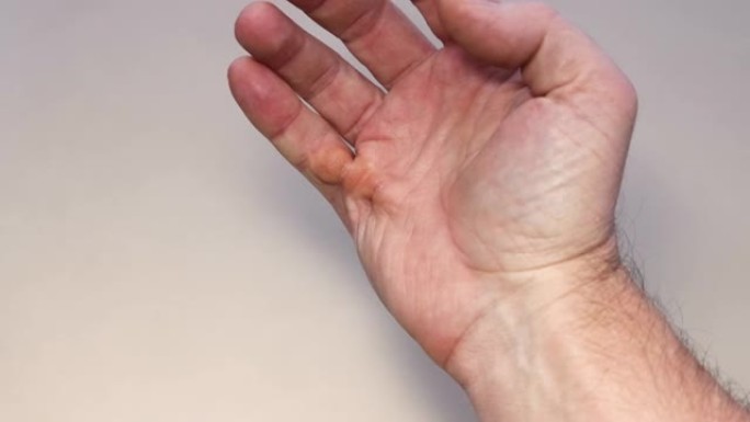 Dupuytren的小指在人的手掌上挛缩