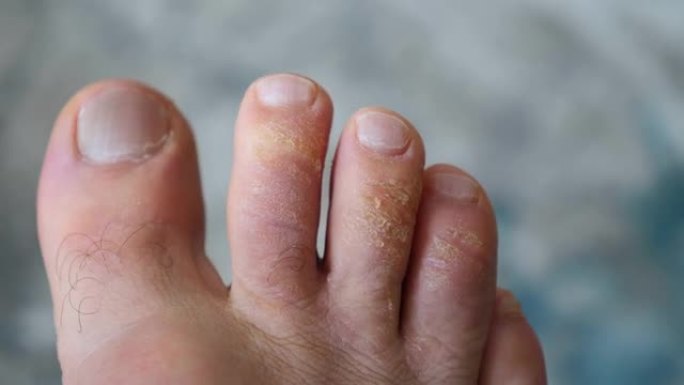 脚趾上的老茧和真菌，足部真菌病，脚部瘙痒病，