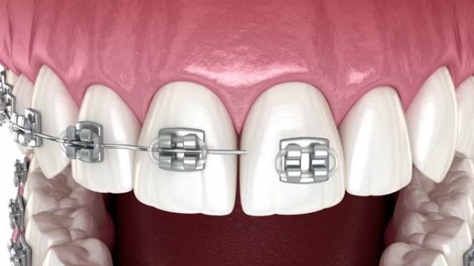 牙套放置，正畸治疗。牙科3D动画