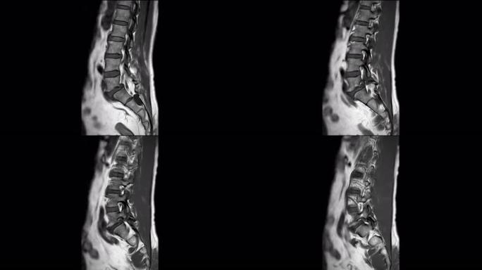 MRI l-s脊柱或腰椎矢状位T1W诊断脊髓压迫。