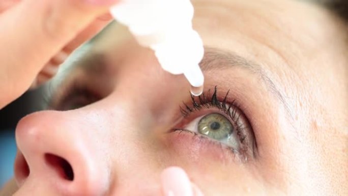 妇女将眼药水倒入红眼并伴有结膜炎或青光眼的特写镜头