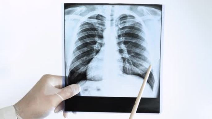 人肺x光上的肺结核。医生在白色背景上分析肺部的x射线