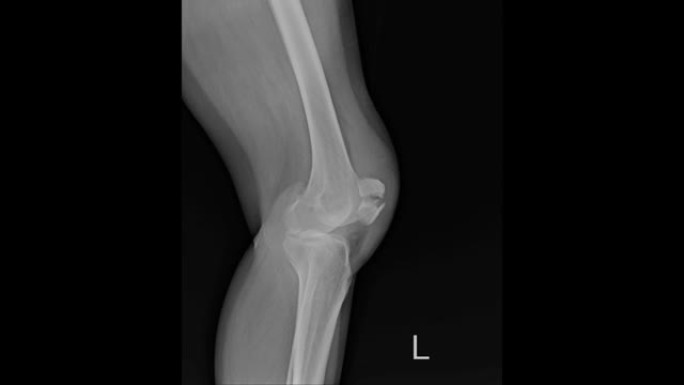 膝关节x线骨骨折