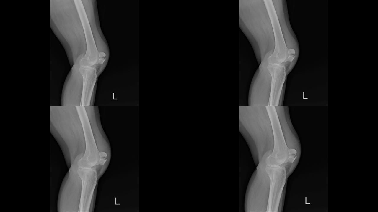 膝关节x线骨骨折