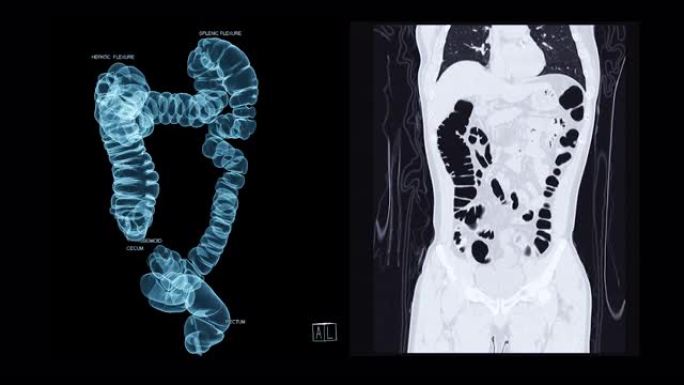 CT结肠造影三维渲染。