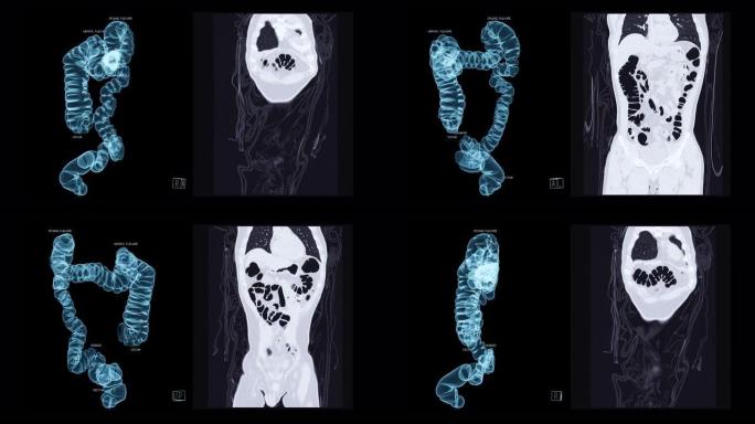 CT结肠造影三维渲染。