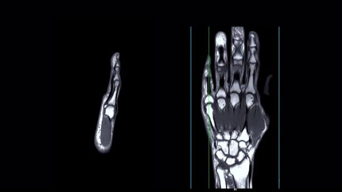 MRI手PDW用于诊断骨关节炎，类风湿和韧带撕裂。