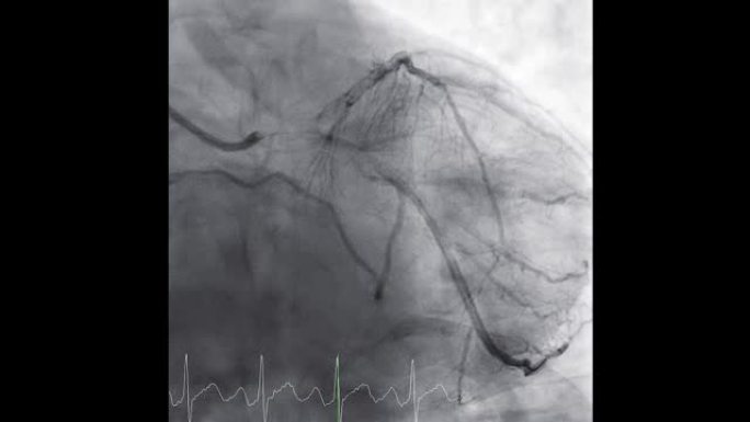 显示冠状动脉的心导管检查以诊断心脏骤停。