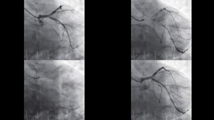 显示冠状动脉的心导管检查以诊断心脏骤停。