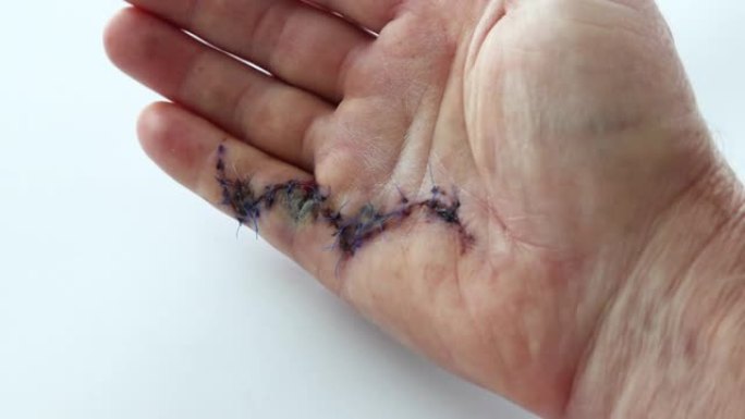 手术后Dupuytren的小指在人的手掌上挛缩
