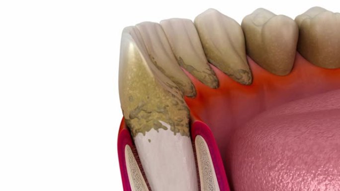 磨牙与龋齿的进展。医学上精确的牙齿3D动画