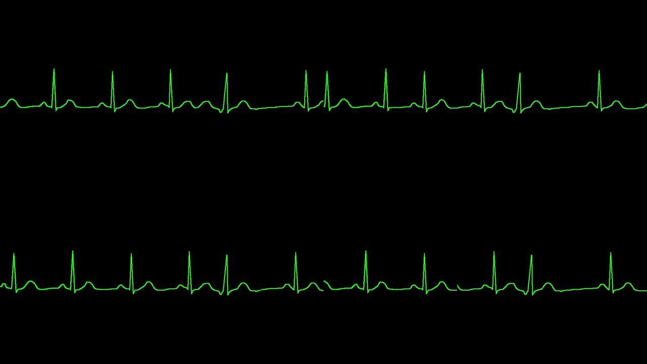 心电图显示过早的交界性收缩心律失常