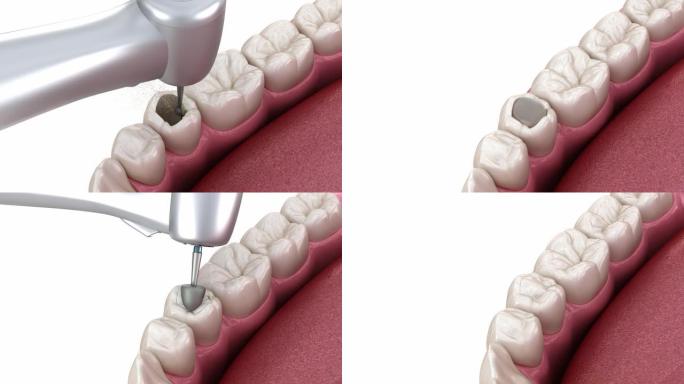 前磨牙修复复合充填。医学上精确的牙齿3D动画