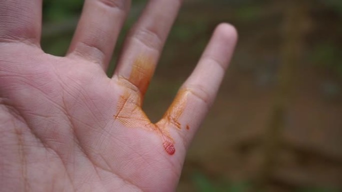 手上的伤口被滴下了红色的药作为缓解剂来治愈