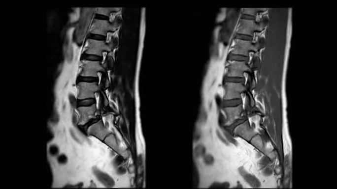 MRI l-s脊柱或腰椎矢状位T1W和T2W诊断脊髓压迫。