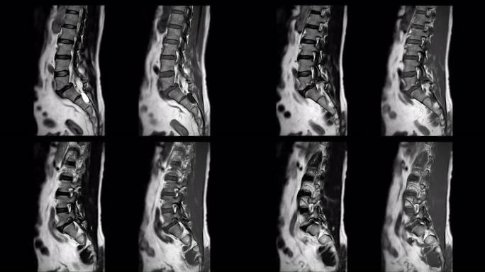 MRI l-s脊柱或腰椎矢状位T1W和T2W诊断脊髓压迫。
