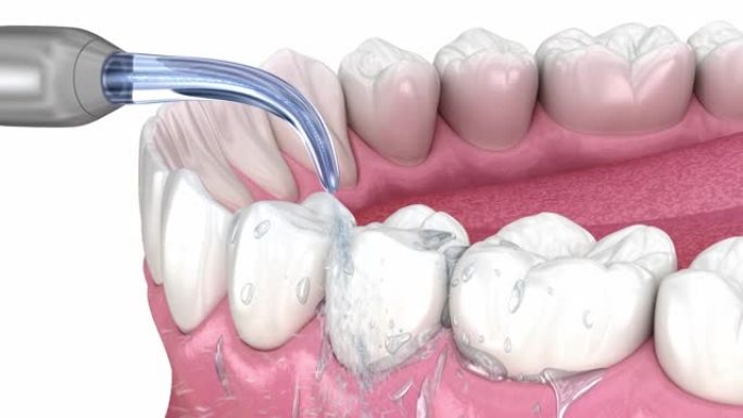 冲洗器，水牙齿清洁。医学上精确的口腔卫生3D动画。