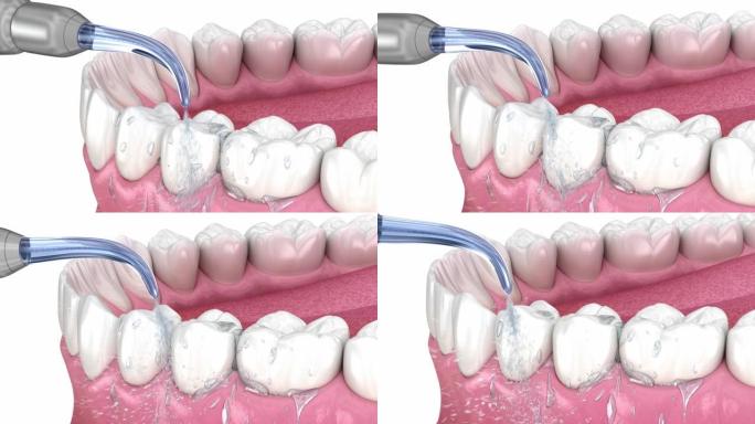 冲洗器，水牙齿清洁。医学上精确的口腔卫生3D动画。