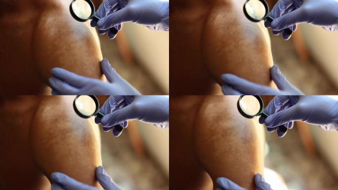 医生皮肤科医生使用放大镜特写4k电影慢动作检查白癜风患者的皮肤