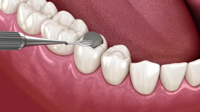 前磨牙修复复合充填。医学上精确的牙齿3D动画