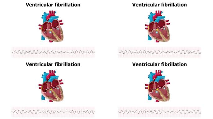 心室颤动 (VF) 心脏动画