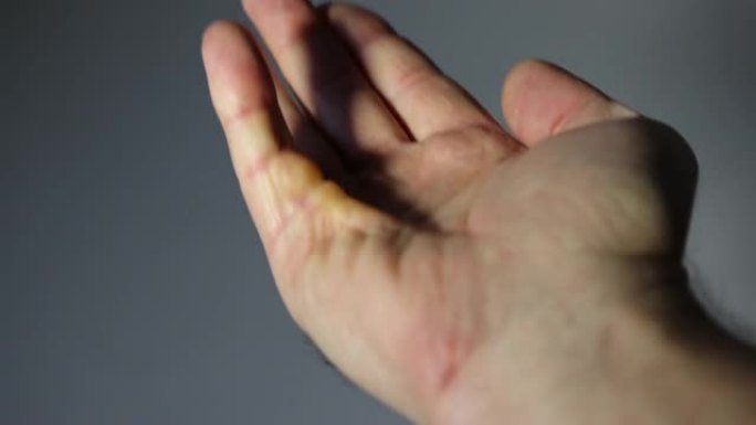 Dupuytren的小指在人的手掌上挛缩
