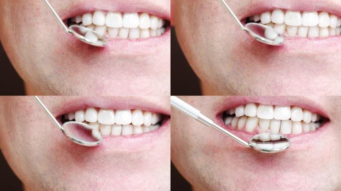 特写。用特殊的牙镜检查用贴面检查牙齿。