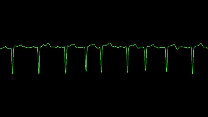 心电图显示心房颤动心律失常