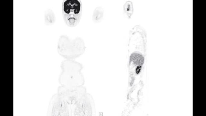 PET ct扫描 (正电子发射断层扫描) 的全身3d渲染图像红色色调轴视图，用于检测肿瘤术后复发。