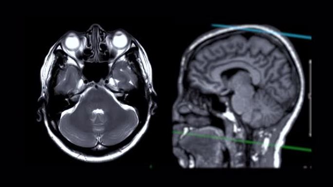 MRI脑轴T2W伴矢状位t1w。
