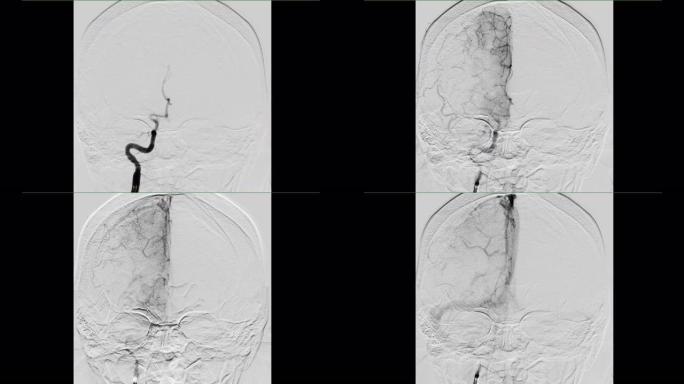 脑血管造影。