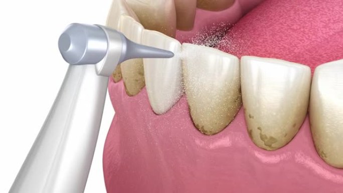 冲洗器，水牙齿清洁。医学上精确的口腔卫生3D动画