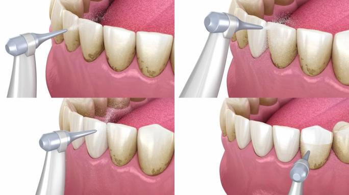 冲洗器，水牙齿清洁。医学上精确的口腔卫生3D动画