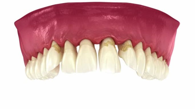 牙周炎和牙龈衰退动力学，牙齿脱落。牙科3D动画