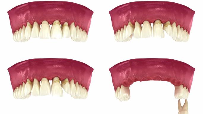牙周炎和牙龈衰退动力学，牙齿脱落。牙科3D动画