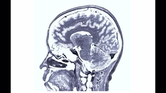 MRI脑矢状面T1W可以帮助医生寻找出血、肿胀、肿瘤、感染、炎症、损伤或中风疾病等疾病。